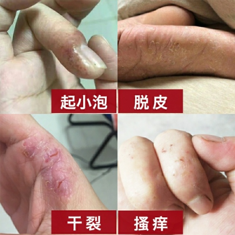 momo-山西省·太原市·小店区--请各位网红达人,根据我们的优乐臣(主要用于皮治疗皮肤病,手脚水泡脱皮瘙痒干裂,产品赠送),创作相关的短视频,短视频要求如下:说明用途,讲清购买方式,网购。创作好之后,请将短视频发布到抖音、快手等平台,